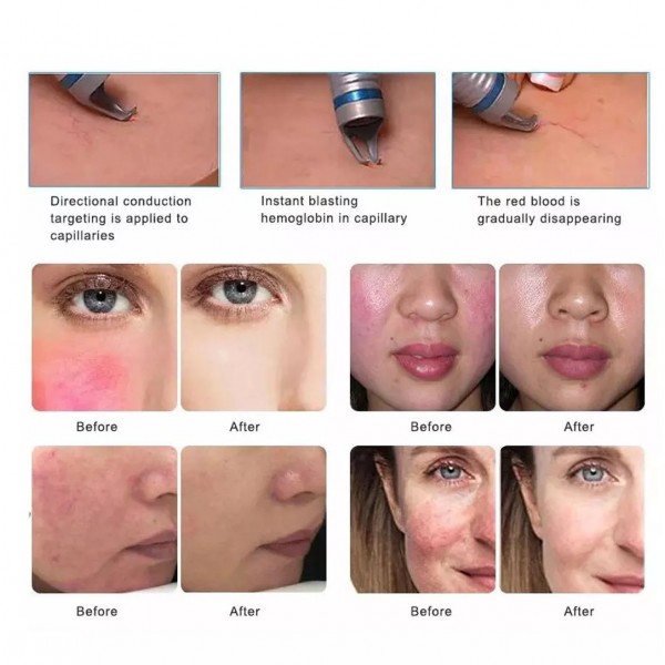 Aparat Dioda Laser 5in1... 2